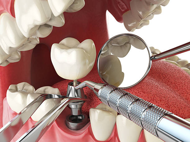 Best Chipped Tooth Repair Near Me  in Buffalo Center, IA